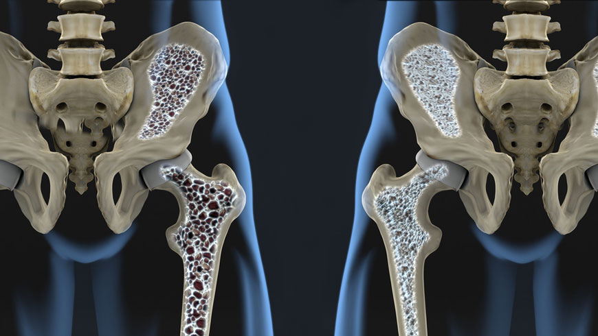 Bone density test: benefit of Red Clover Extract