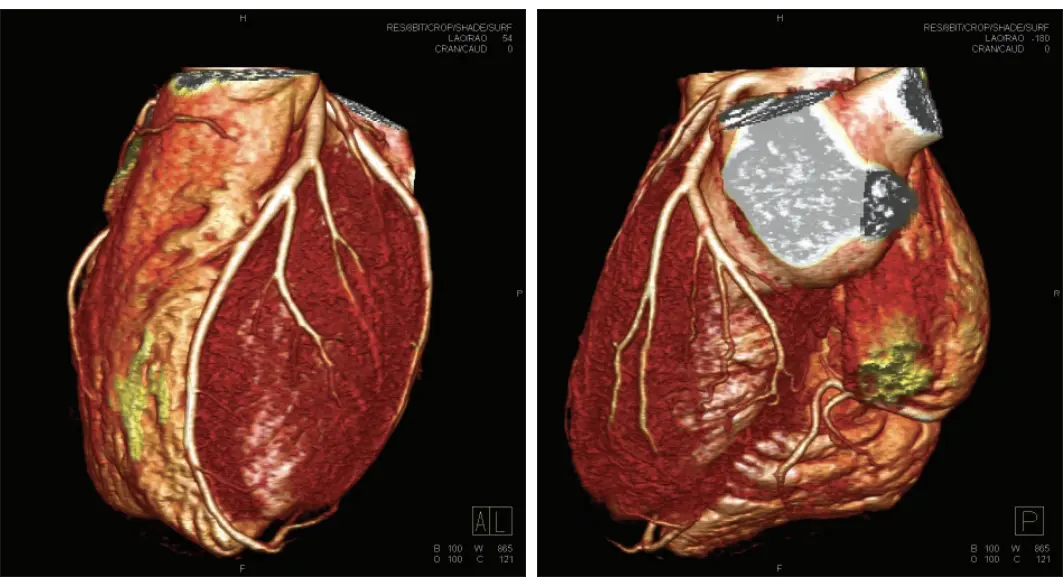 3d reconstruction of the heart