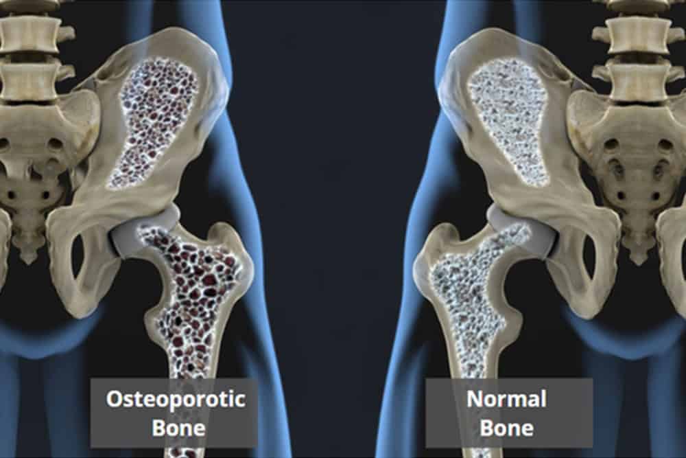 Bone Mineral Density